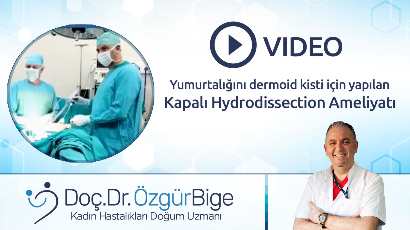 Yumurtalığın dermoid kisti için yapılan kapalı hydrodissection ameliyatı